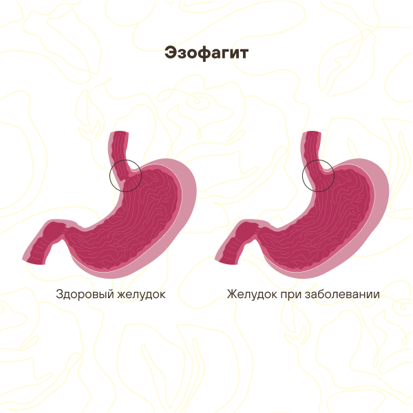 Эзофагит желудка